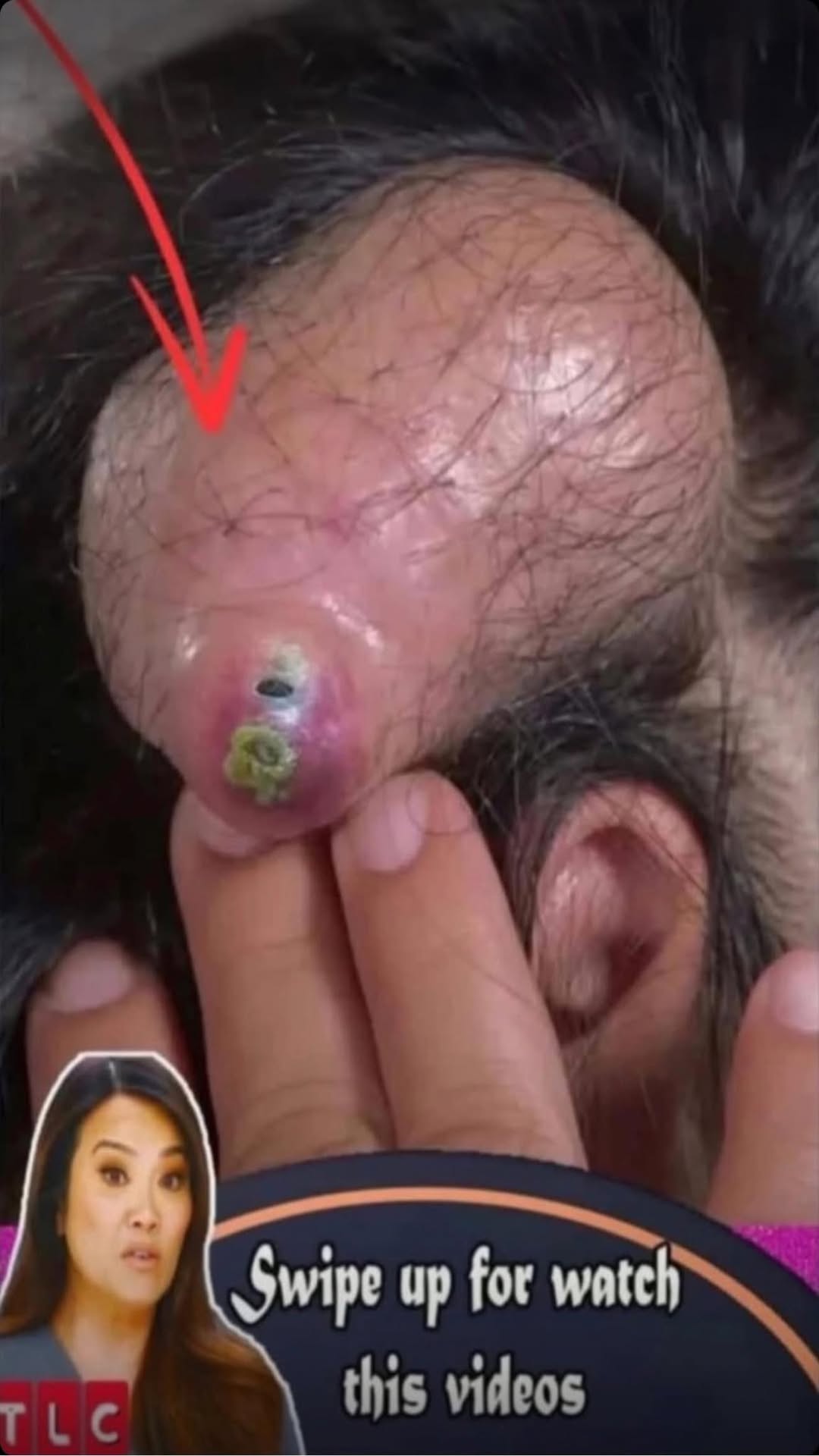 Best 15 Tips For Squeezing Blackheads On Nose