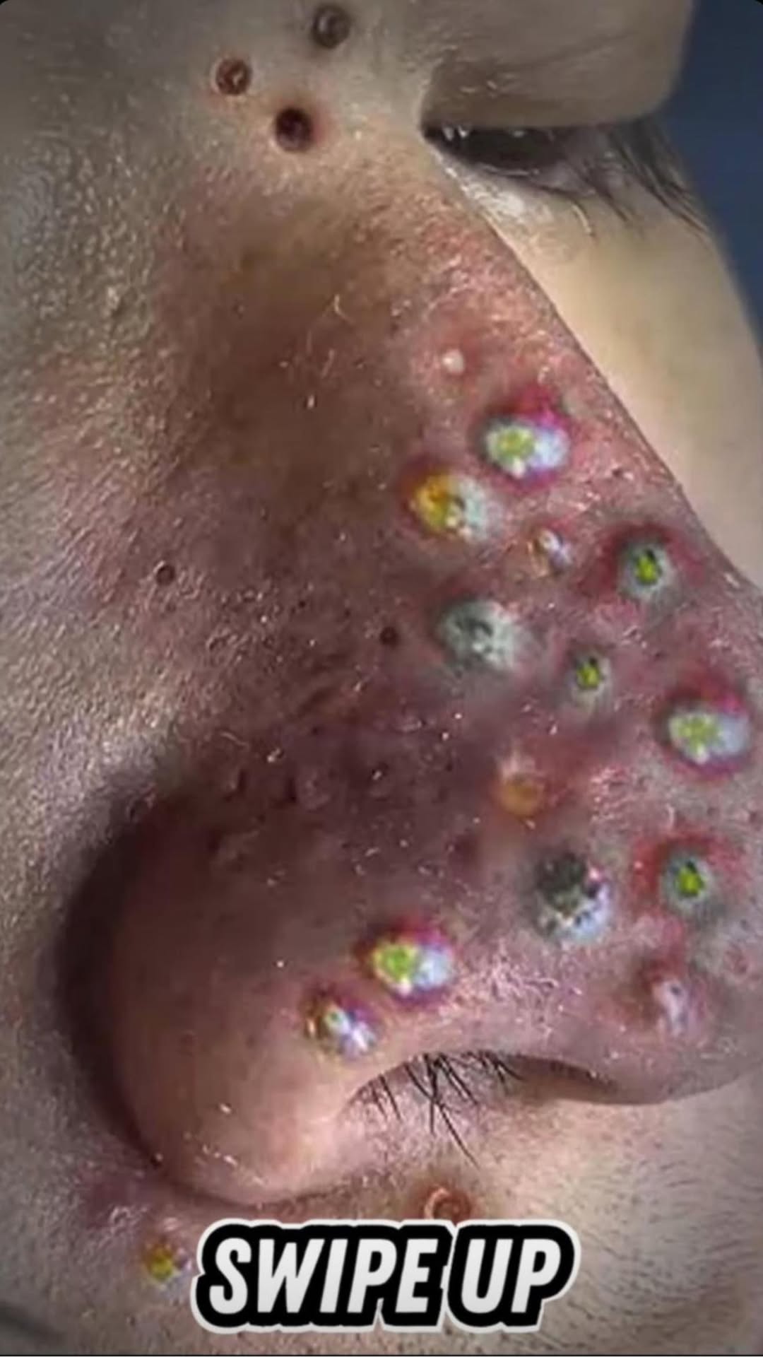 Best 15 Tips For Squeezing Blackheads On Nose
