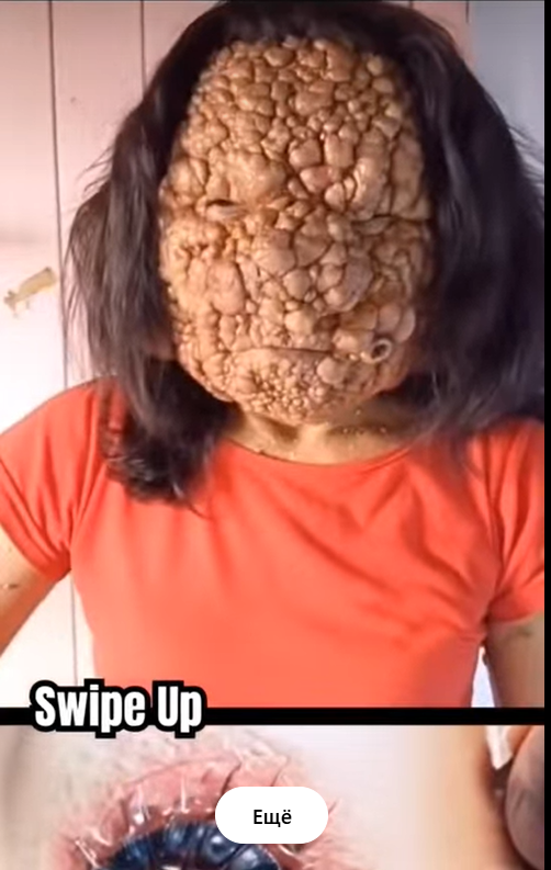 Acne occurs when hair follicles become clogged.